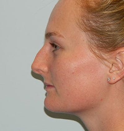 Rhinoplasty Before & After Gallery - Patient 133066779 - Image 1