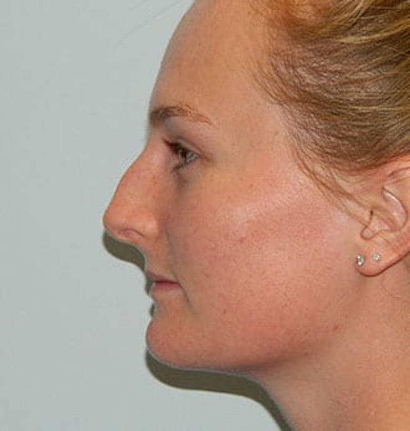 Rhinoplasty Before & After Gallery - Patient 133066779 - Image 1