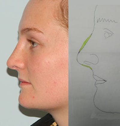 Rhinoplasty Before & After Gallery - Patient 133066779 - Image 2