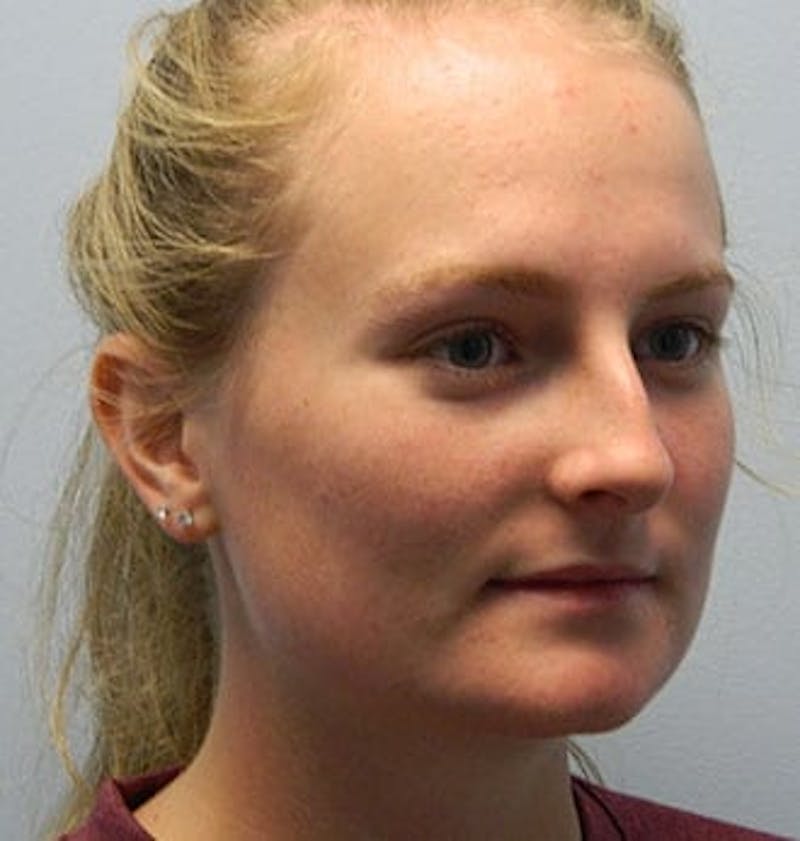 Rhinoplasty Before & After Gallery - Patient 133066779 - Image 3