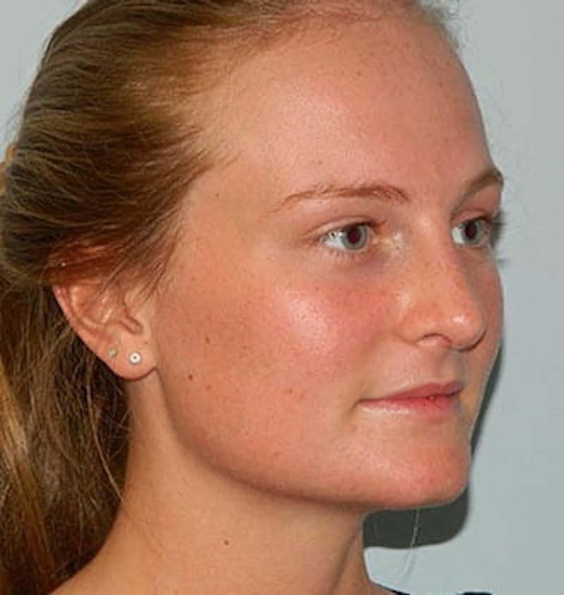 Rhinoplasty Before & After Gallery - Patient 133066779 - Image 4