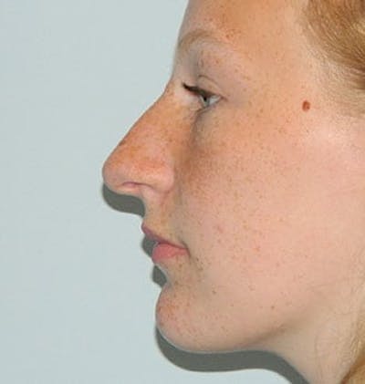 Rhinoplasty Before & After Gallery - Patient 133066785 - Image 1
