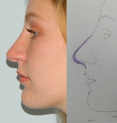 Rhinoplasty Before & After Gallery - Patient 133066785 - Image 2