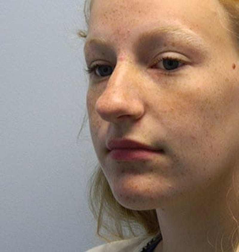 Rhinoplasty Before & After Gallery - Patient 133066785 - Image 3