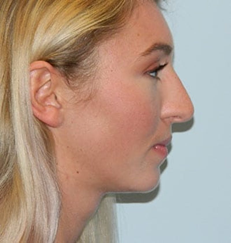 Rhinoplasty Before & After Gallery - Patient 133066788 - Image 1