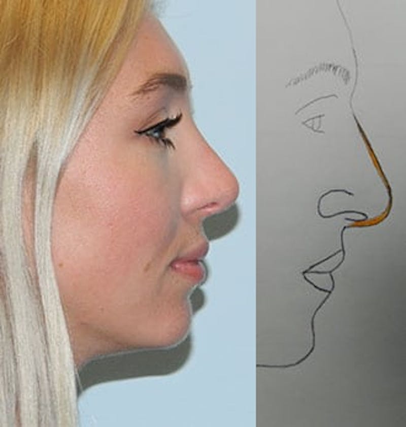 Rhinoplasty Before & After Gallery - Patient 133066788 - Image 2