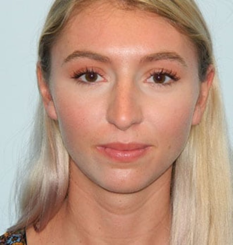 Rhinoplasty Before & After Gallery - Patient 133066788 - Image 3