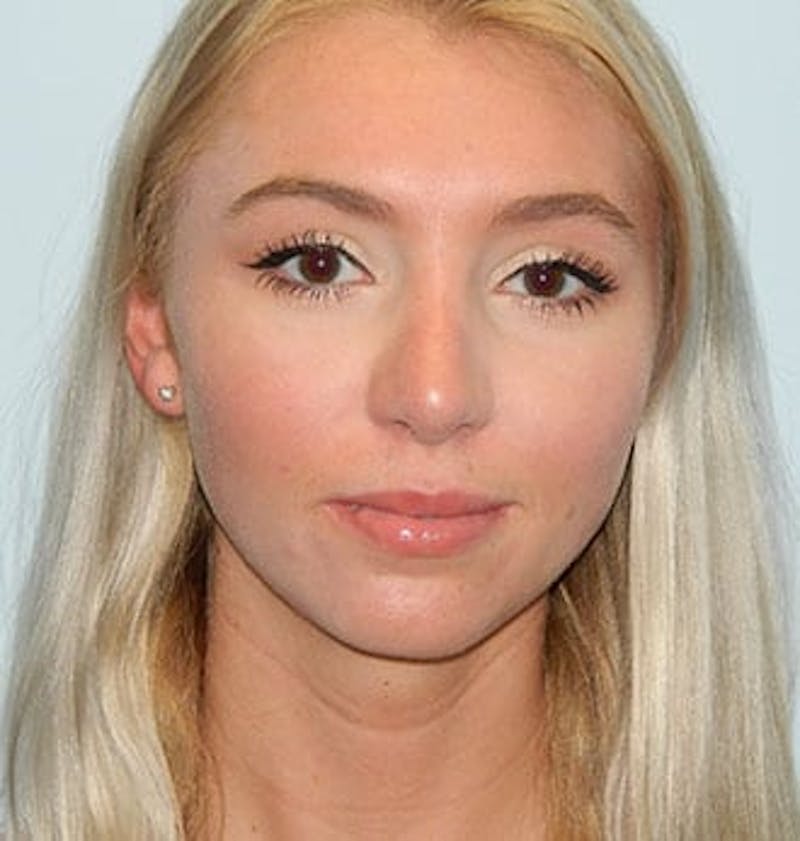 Rhinoplasty Before & After Gallery - Patient 133066788 - Image 4