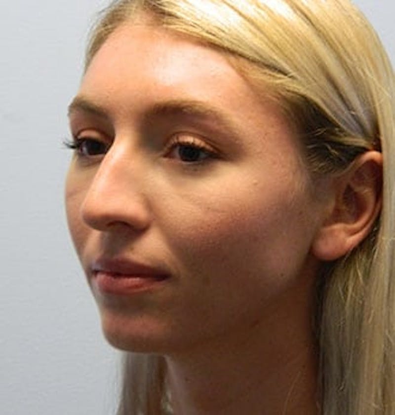 Rhinoplasty Before & After Gallery - Patient 133066788 - Image 5
