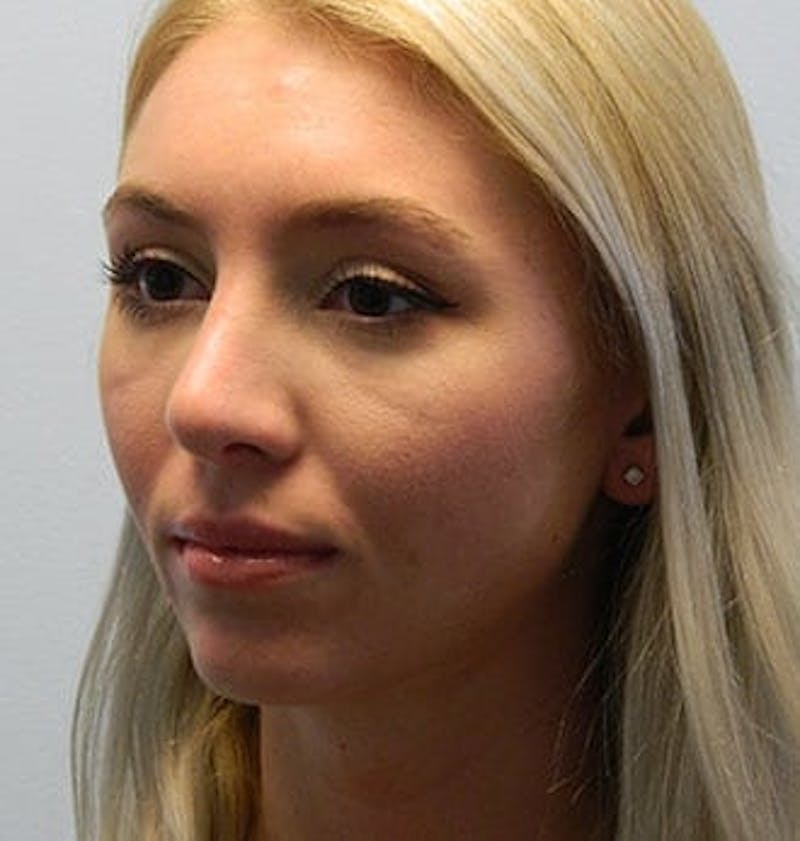 Rhinoplasty Before & After Gallery - Patient 133066788 - Image 6
