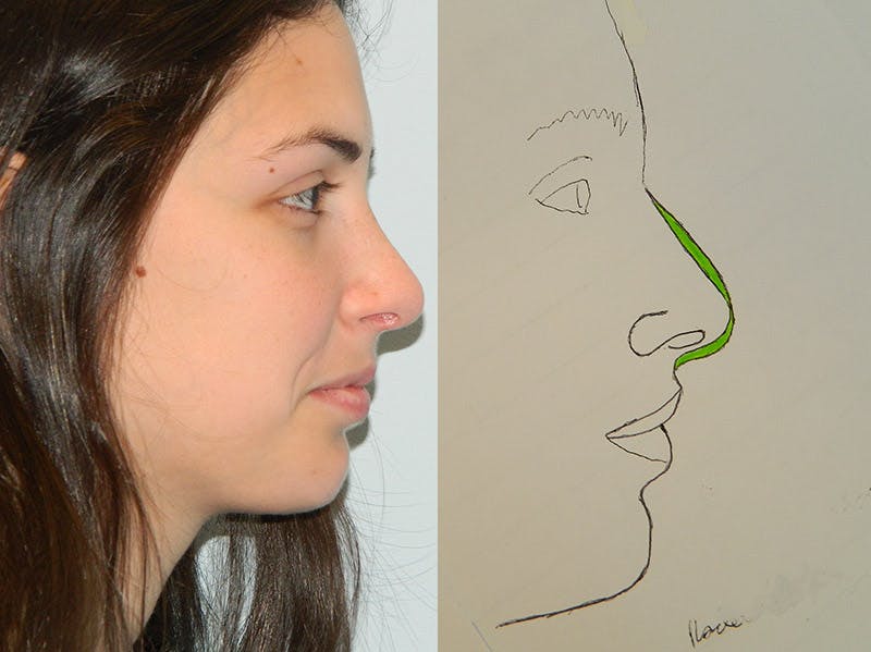 Rhinoplasty Before & After Gallery - Patient 133066789 - Image 2