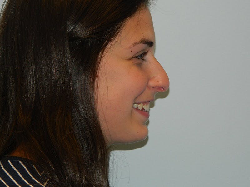 Rhinoplasty Before & After Gallery - Patient 133066789 - Image 3