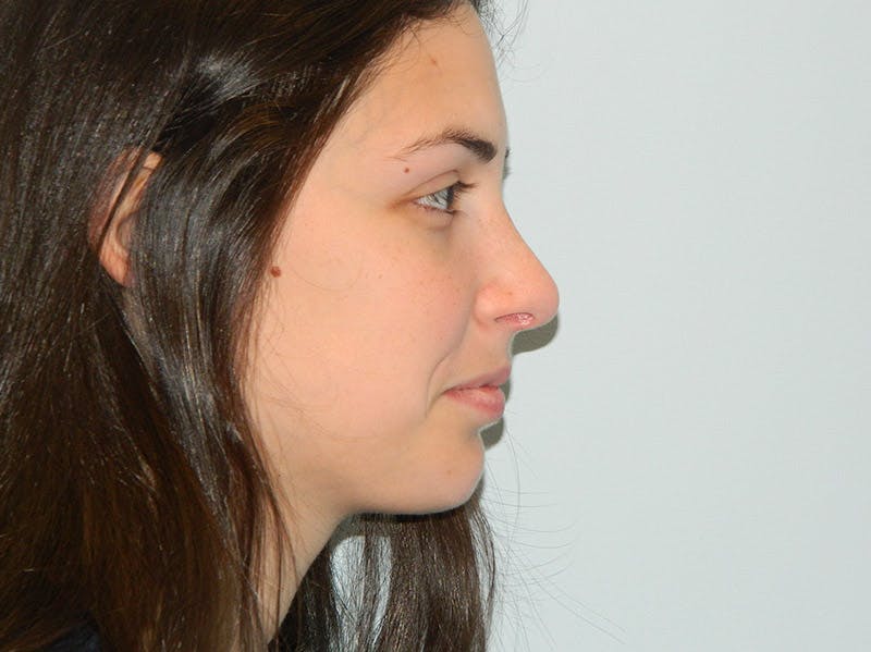 Rhinoplasty Before & After Gallery - Patient 133066789 - Image 4