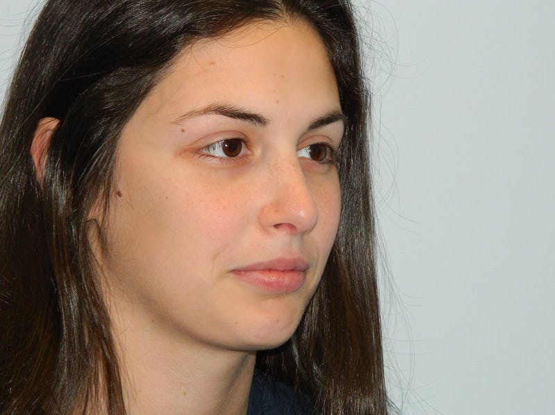 Rhinoplasty Before & After Gallery - Patient 133066789 - Image 6