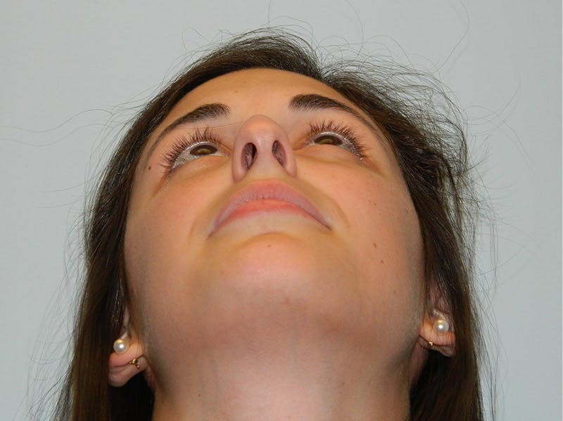 Rhinoplasty Before & After Gallery - Patient 133066789 - Image 7