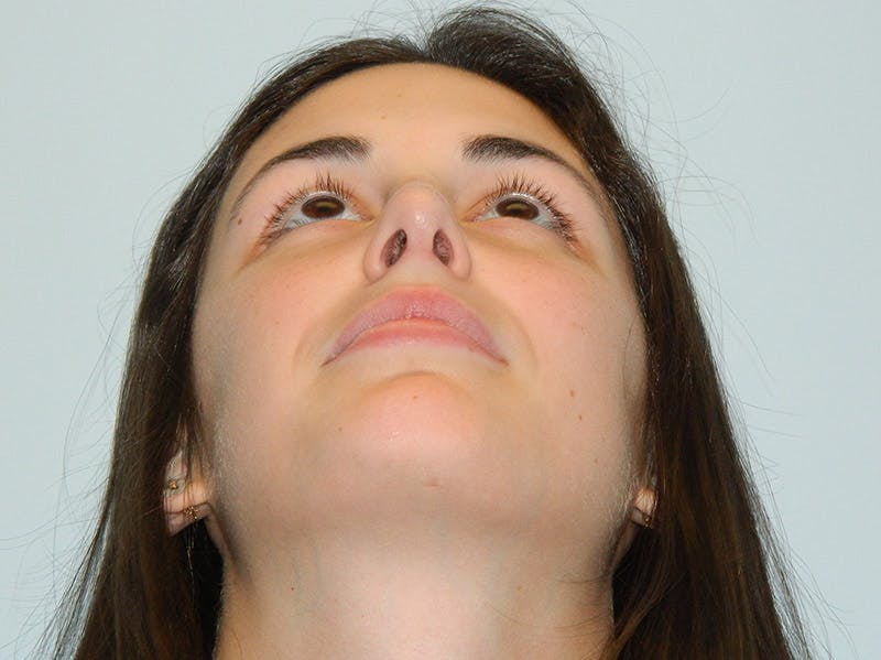 Rhinoplasty Before & After Gallery - Patient 133066789 - Image 8