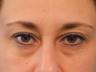 Blepharoplasty (Eyelid Lift) Before & After Gallery - Patient 137042264 - Image 1