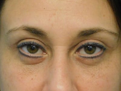 Blepharoplasty (Eyelid Lift) Before & After Gallery - Patient 137042264 - Image 2