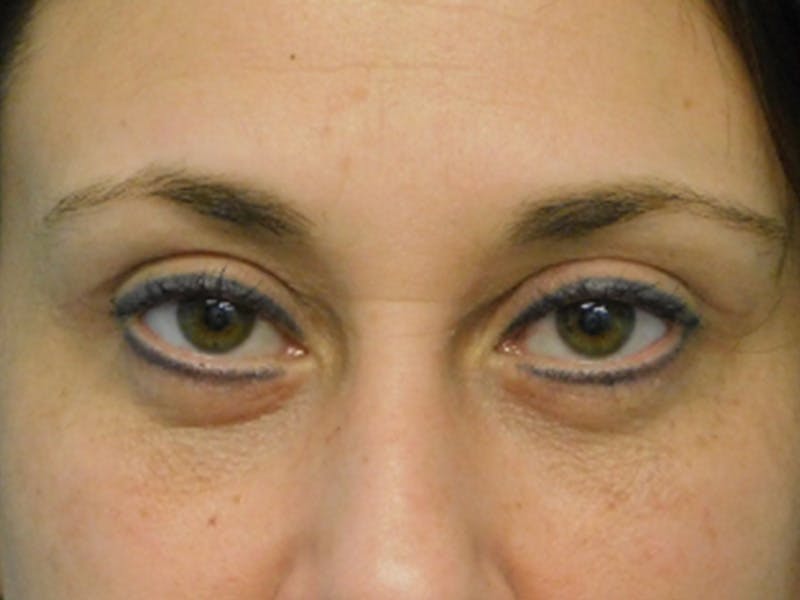Blepharoplasty (Eyelid Lift) Before & After Gallery - Patient 137042264 - Image 2