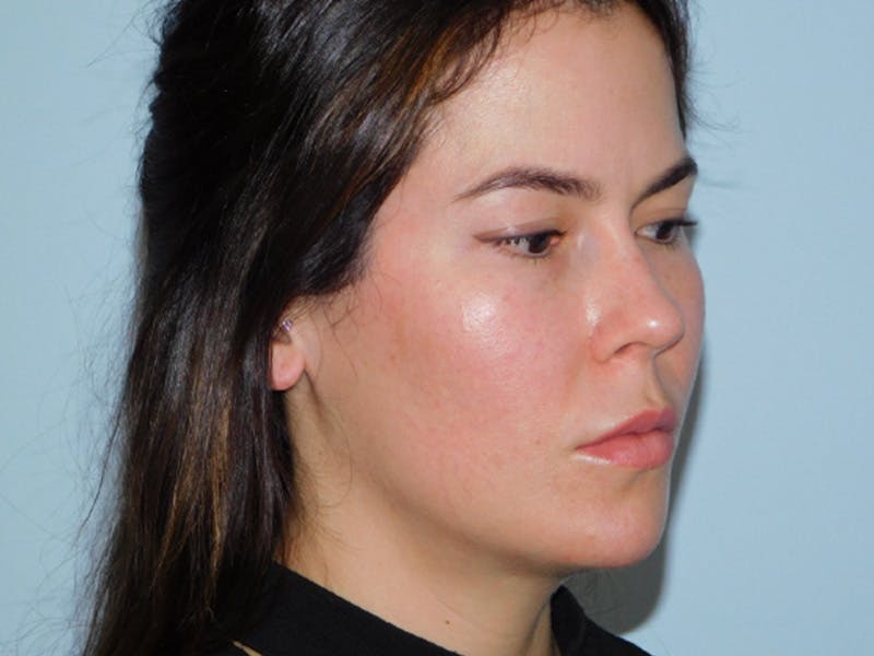 Ultherapy Before & After Gallery - Patient 137042285 - Image 3