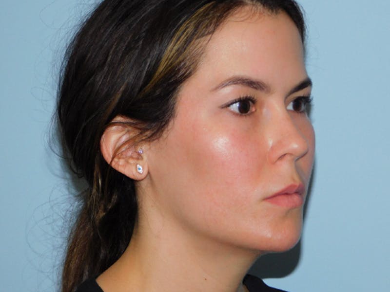 Ultherapy Before & After Gallery - Patient 137042285 - Image 4