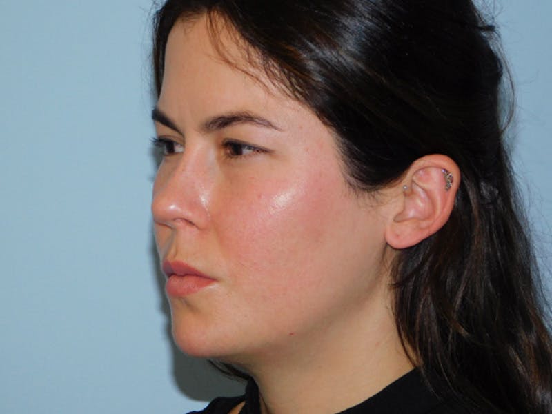 Ultherapy Before & After Gallery - Patient 137042285 - Image 1