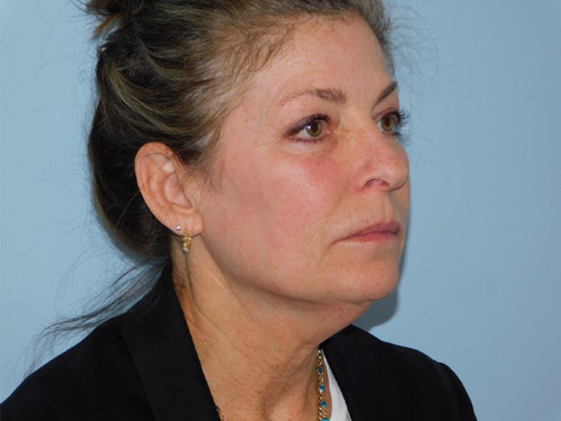 Facelift Before & After Gallery - Patient 137042273 - Image 3