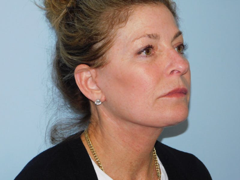 Facelift Before & After Gallery - Patient 137042273 - Image 4