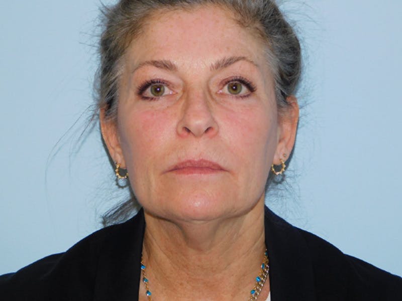 Facelift Before & After Gallery - Patient 137042273 - Image 5