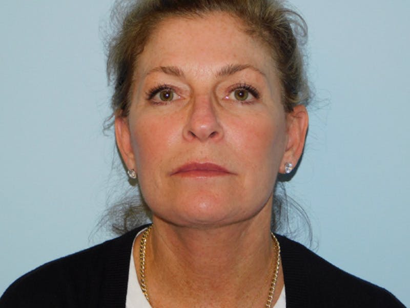 Facelift Before & After Gallery - Patient 137042273 - Image 6