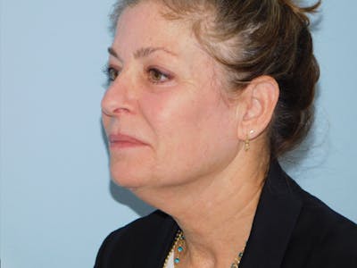 Facelift Before & After Gallery - Patient 137042273 - Image 1