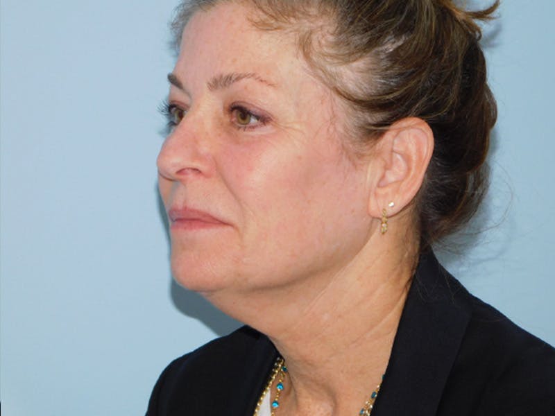 Facelift Before & After Gallery - Patient 137042273 - Image 1