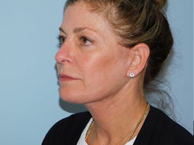 Facelift Before & After Gallery - Patient 137042273 - Image 2