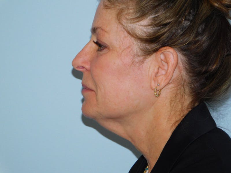 Facelift Before & After Gallery - Patient 137042273 - Image 7