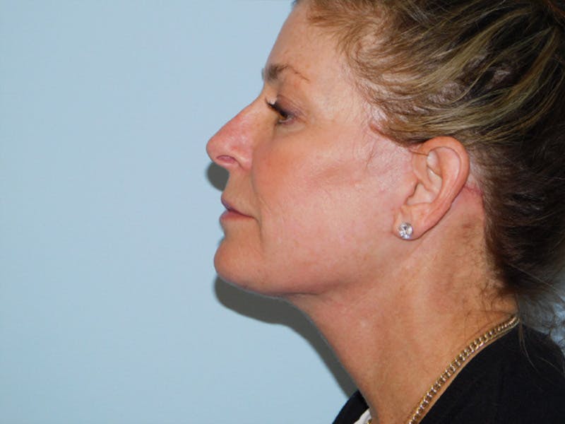 Facelift Before & After Gallery - Patient 137042273 - Image 8