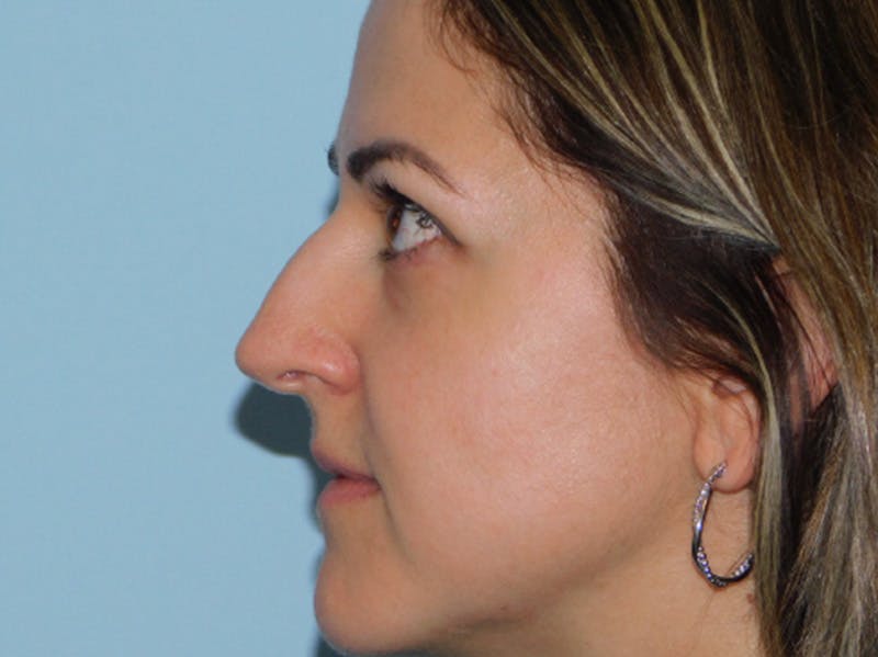 Rhinoplasty Before & After Gallery - Patient 145647066 - Image 1