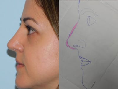 Rhinoplasty Before & After Gallery - Patient 145647066 - Image 2