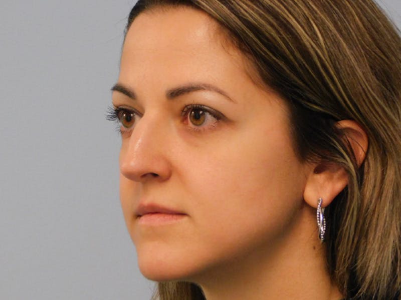 Rhinoplasty Before & After Gallery - Patient 145647066 - Image 3
