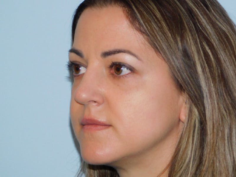 Rhinoplasty Before & After Gallery - Patient 145647066 - Image 4