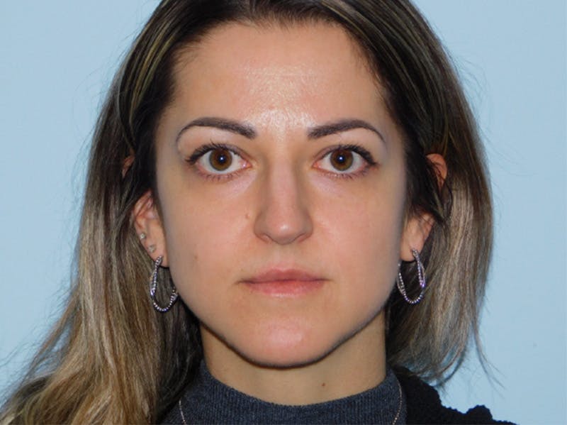 Rhinoplasty Before & After Gallery - Patient 145647066 - Image 5