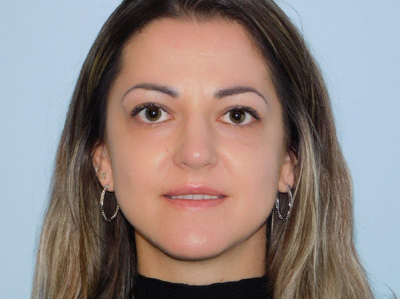 Rhinoplasty Before & After Gallery - Patient 145647066 - Image 6