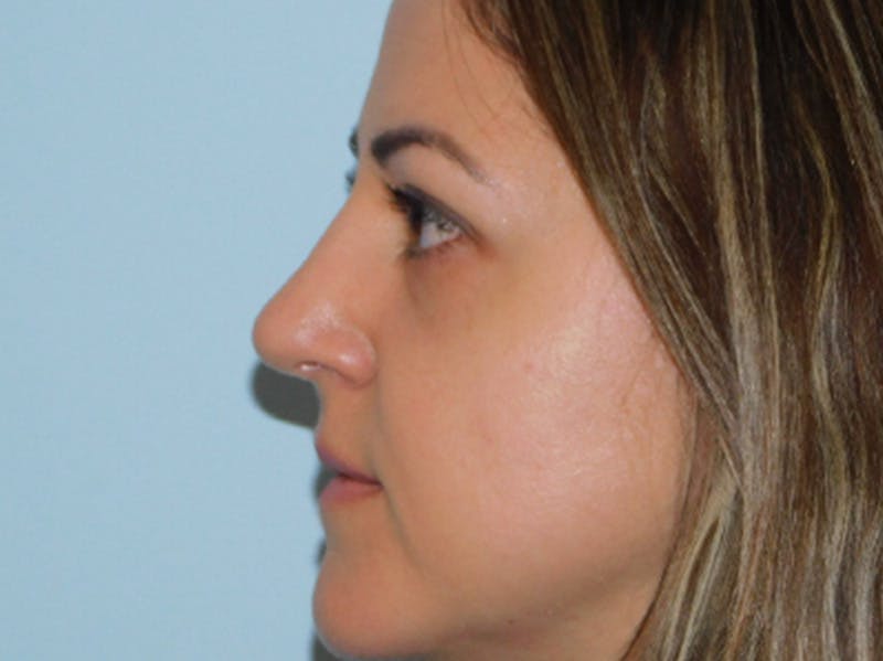 Rhinoplasty Before & After Gallery - Patient 145647066 - Image 8