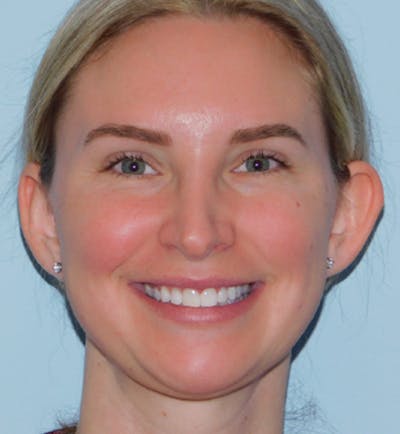 Otoplasty Before & After Gallery - Patient 145647977 - Image 1