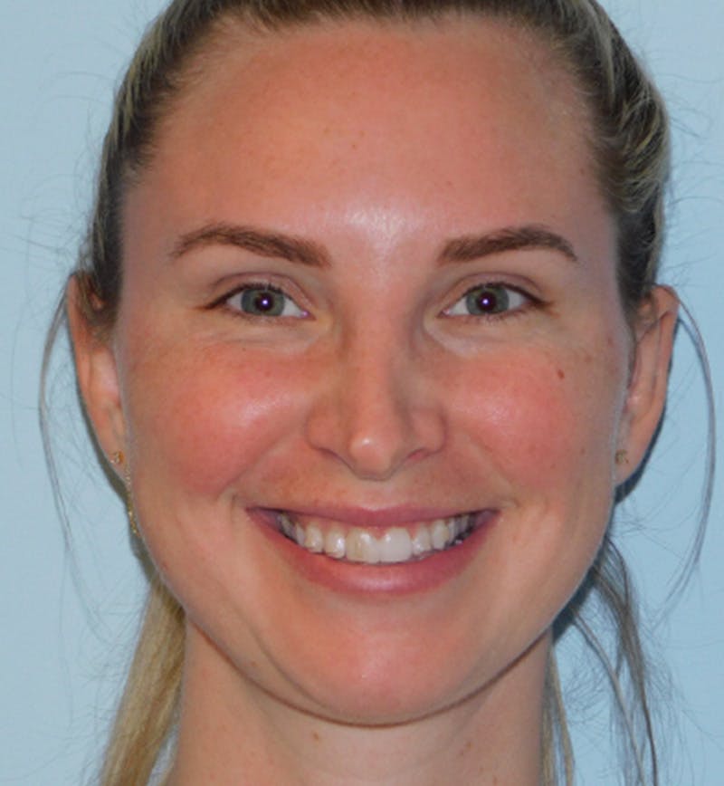Otoplasty Before & After Gallery - Patient 145647977 - Image 2