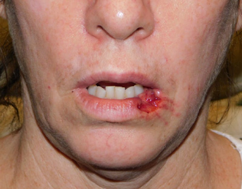 Reconstructive Surgery Before & After Gallery - Patient 145648035 - Image 1