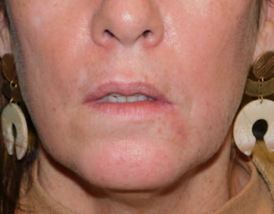 Reconstructive Surgery Before & After Gallery - Patient 145648035 - Image 2