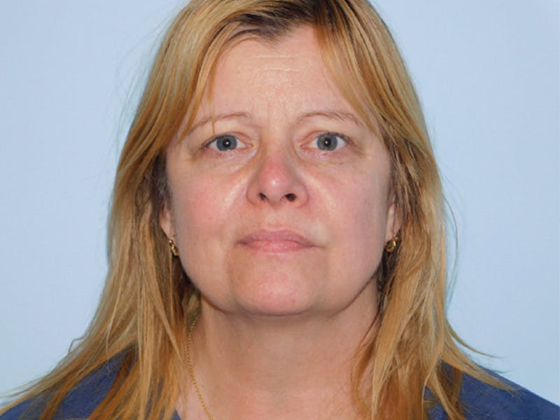 Facelift Before & After Gallery - Patient 145649025 - Image 3
