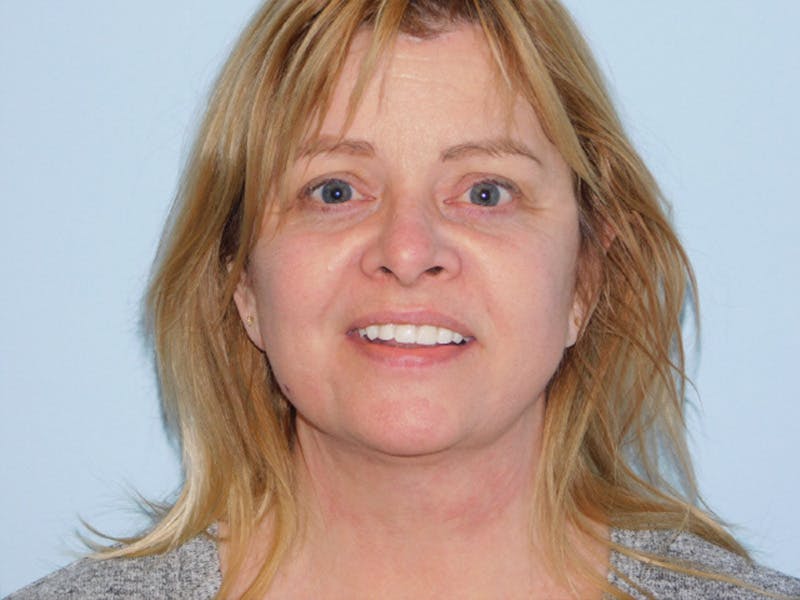 Facelift Before & After Gallery - Patient 145649025 - Image 4