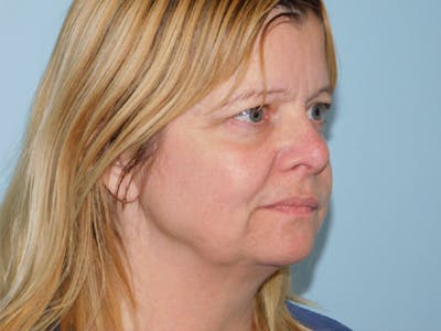 Facelift Before & After Gallery - Patient 145649025 - Image 1