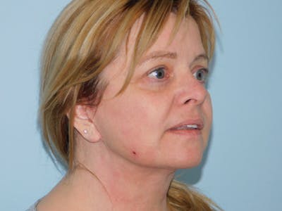 Facelift Before & After Gallery - Patient 145649025 - Image 2